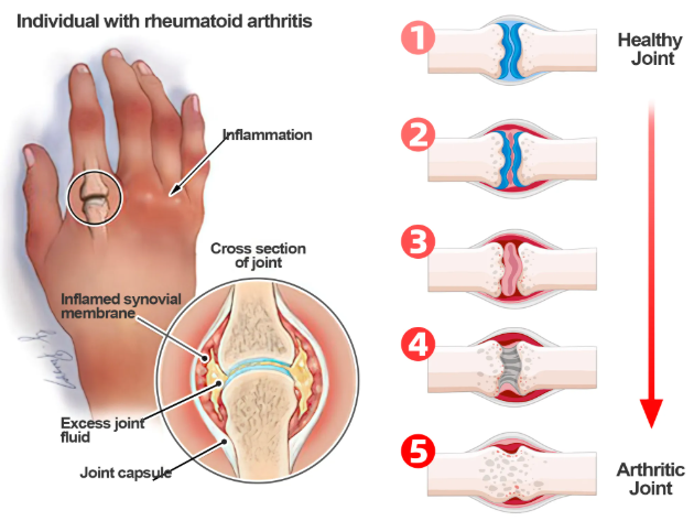 South Moon Bee Venom  Relief Cream | ساوث مون – كريم الجسم العشبي المهدئ